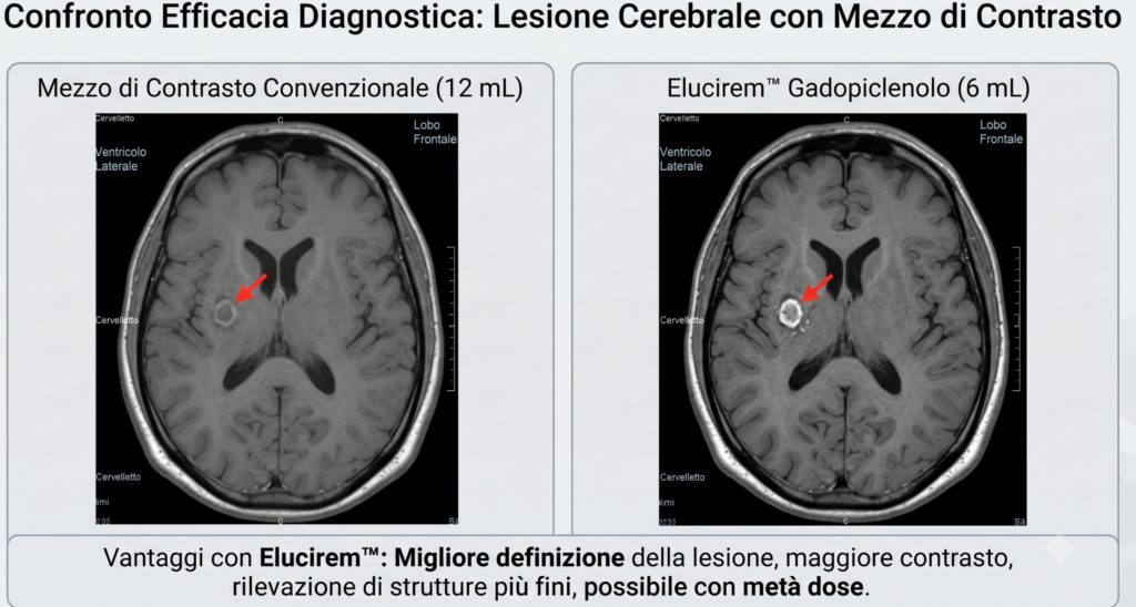 Confronto efficacia diagnostica risonanza magnetica: immagini side-by-side di una lesione cerebrale che mostrano una migliore visibilità con Elucirem™ (gadopiclenolo) rispetto al contrasto convenzionale.